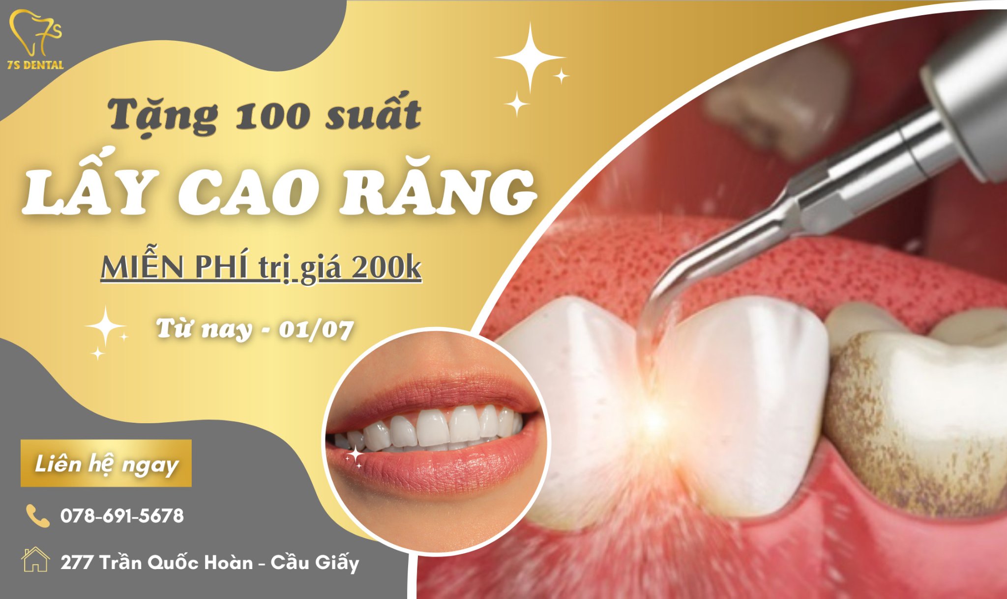Lấy cao răng